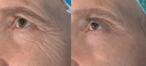 Anti Aging Botox Treatment Boca Raton Glamor Medical