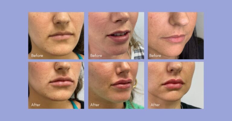 How to Choose The Right Lip Fillers for You