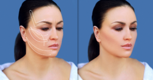 Collagen Thread Lift Sugar Thread Lift Palm Beach