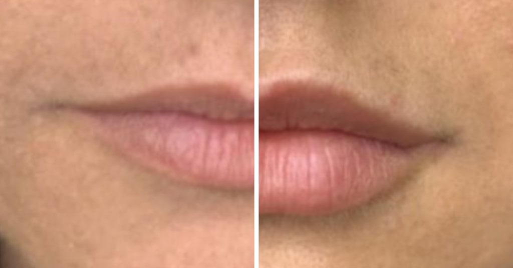 Lip Augmentation Before & After at Glamor Medical