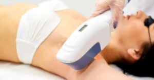 What to Expect from Laser Hair Removal
