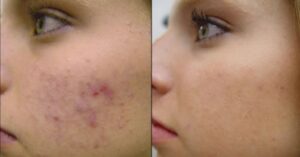 IPL for Pigmented Lesions