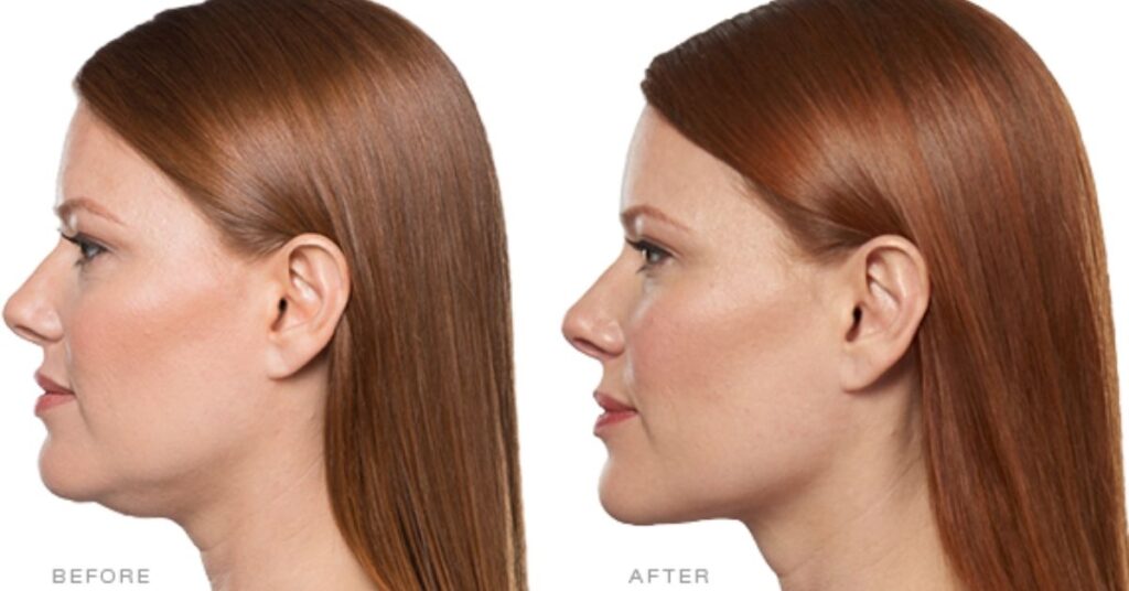 kybella-before-after-photo