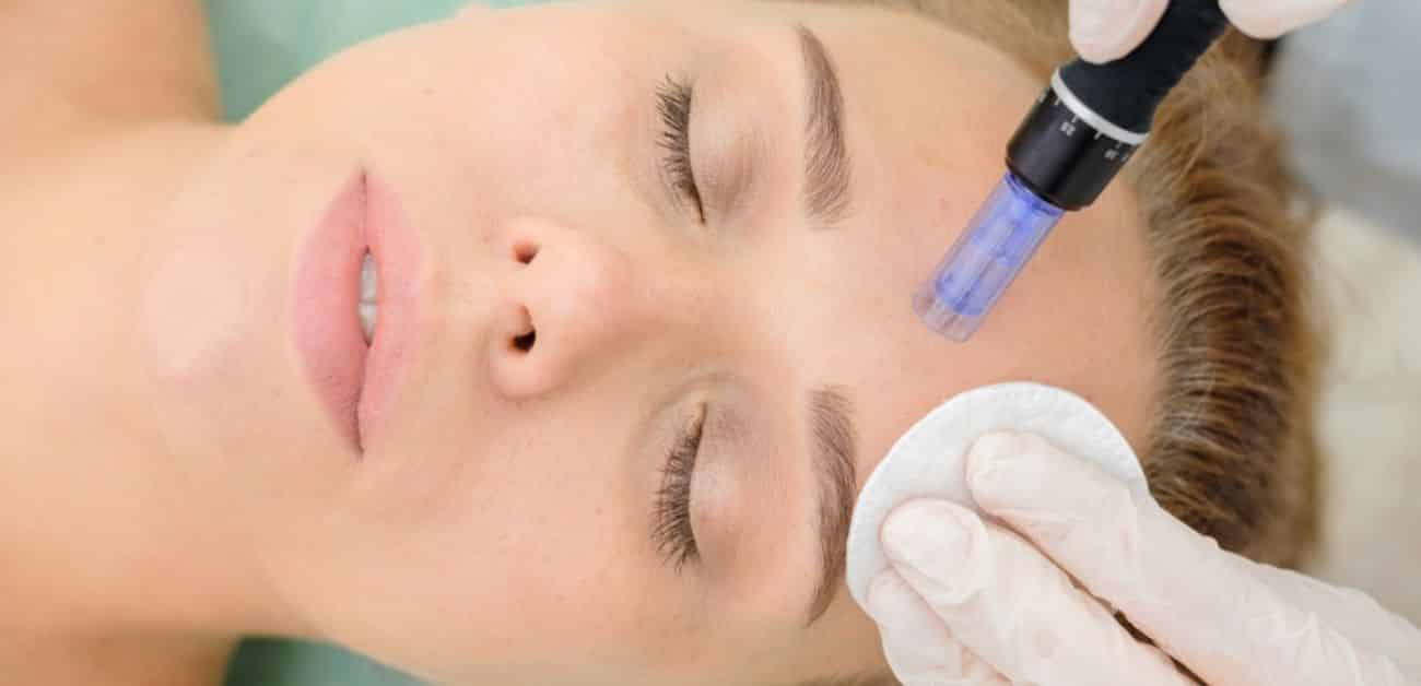 RF Microneedling