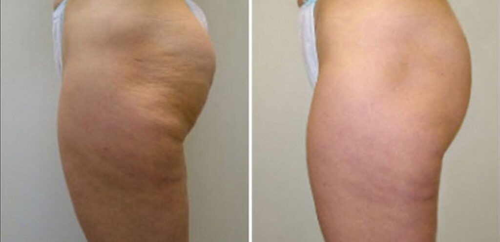 velashape-before-and-after