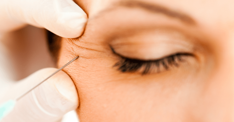 The Ultimate Guide to Botox