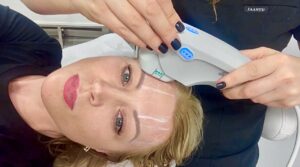 Skin Tightening with Ultherapy