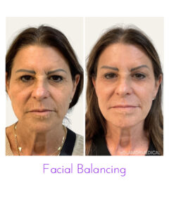 Facial Balancing