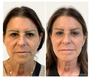 Facial Balancing with Sculptra