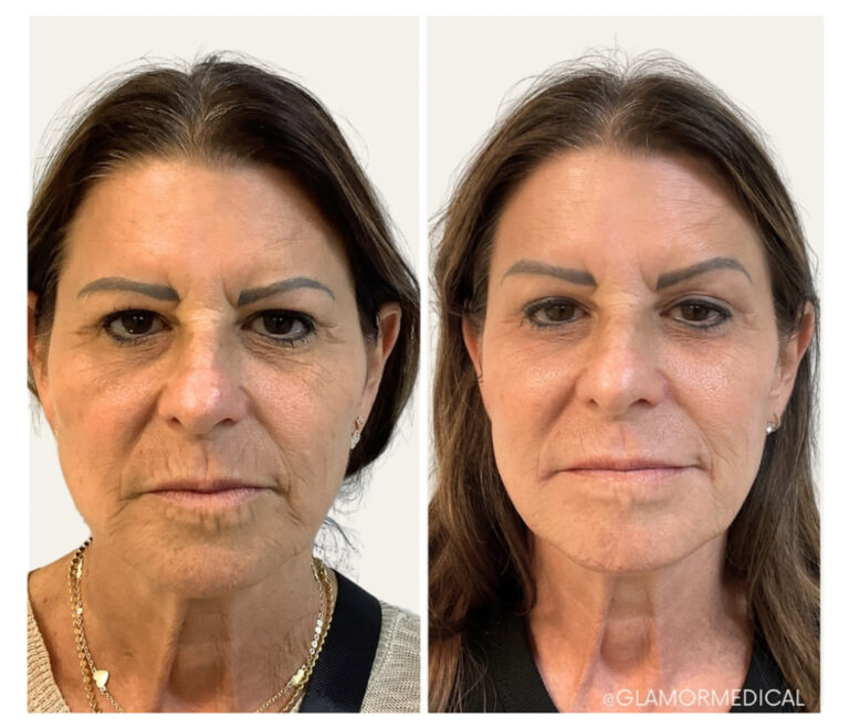 Facial Balancing with Sculptra