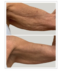 Ultherapy for arm tightening