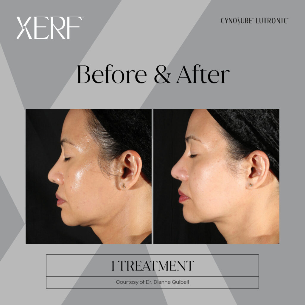 XERF Jawline Lifting Results Before and After