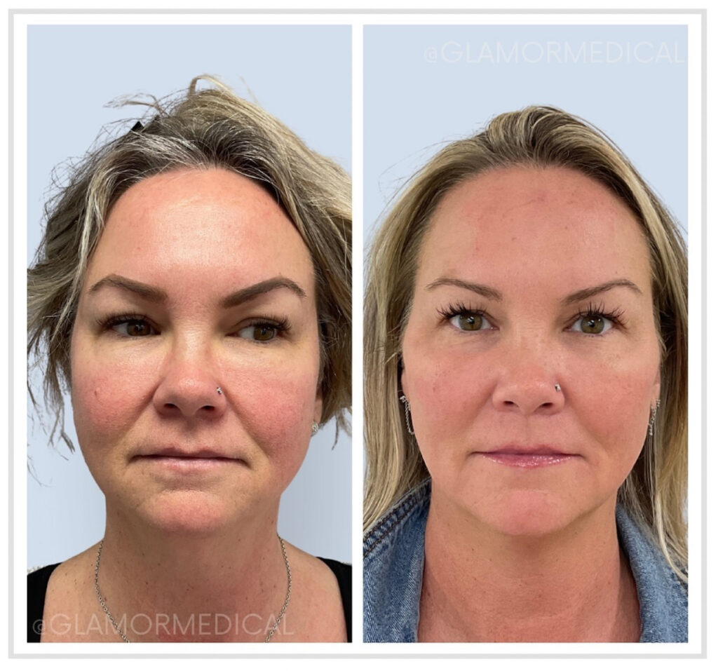 Facial balancing with Sculptra before and after pictures