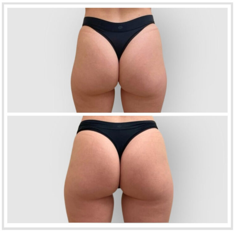 The Non-Surgical Brazilian Butt Lift (BBL) with Sculptra®