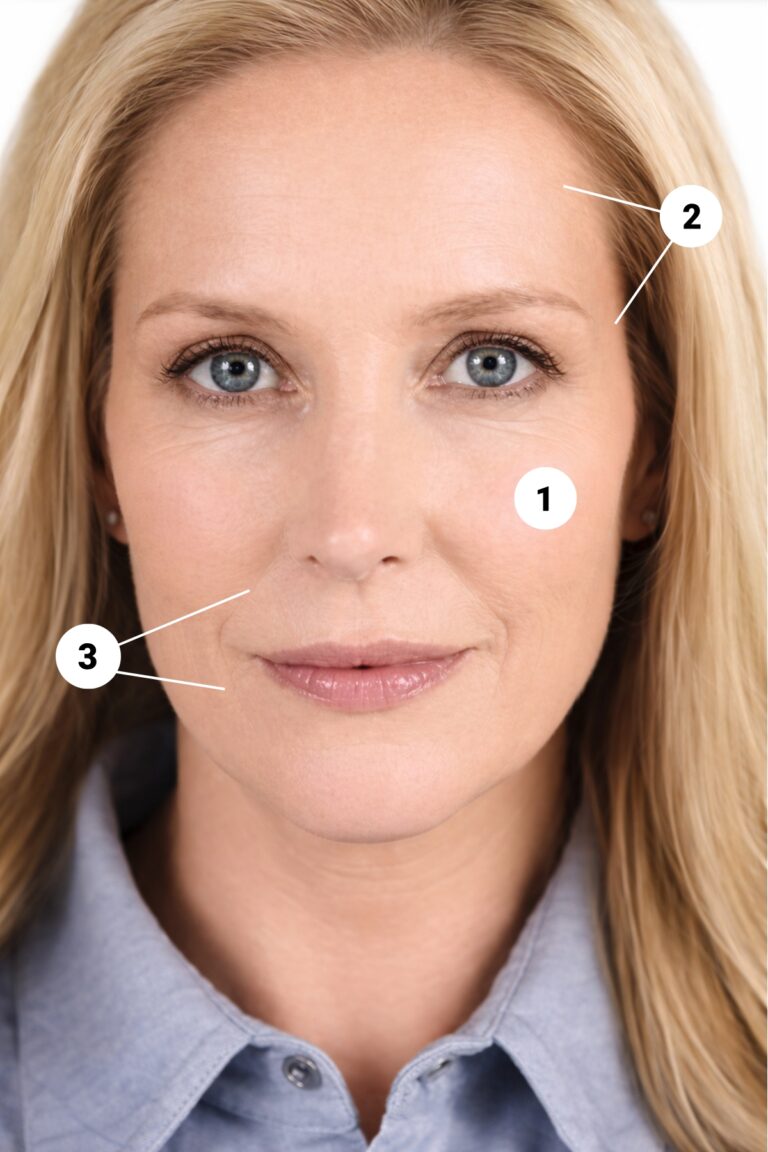 Sculptra injection zones for restoring volume in the temples, mid-face, and jawline at Glamor Medical Boca Raton.