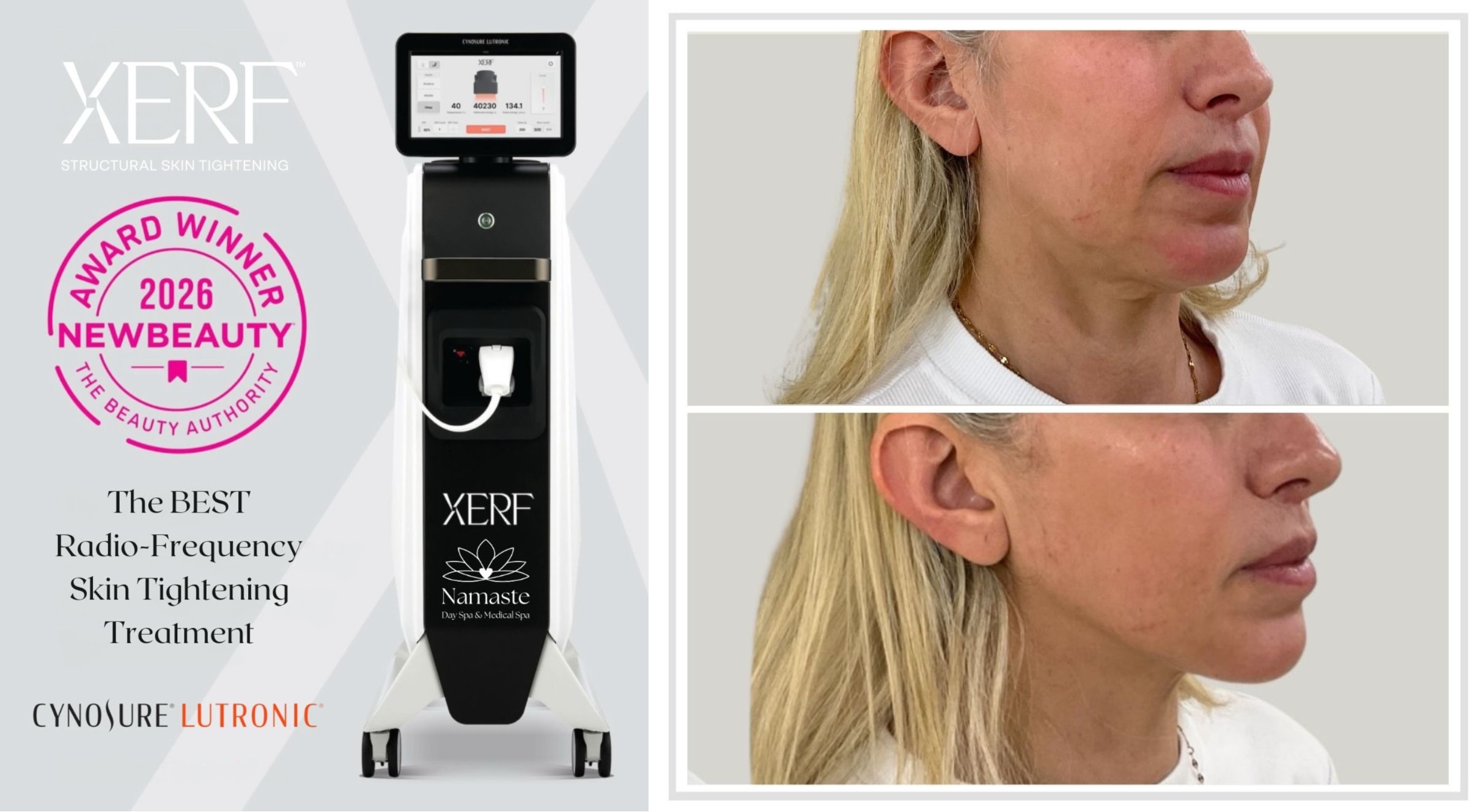 XERF is recognized as the #1 Skin Tightening Treatment Worldwide