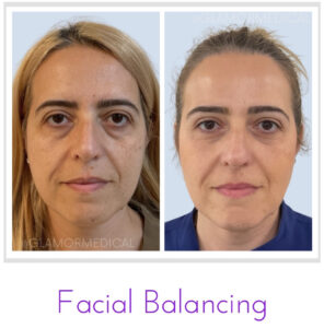 Facial Balancing with Dermal Fillers