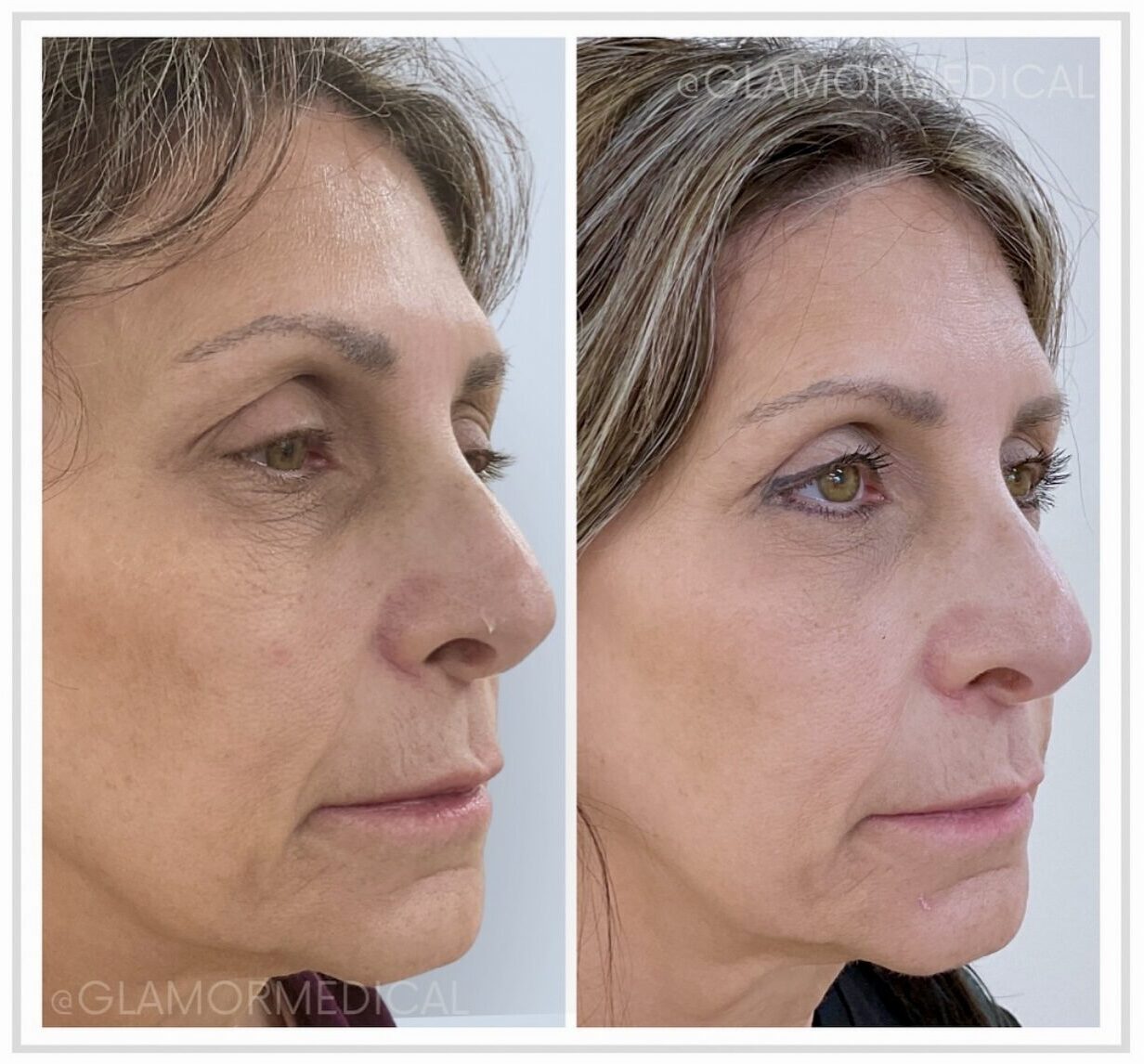 CO2 laser resurfacing results showing visible smoothing of fine lines and texture